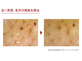 Hình ảnh: Loại bỏ tế bào chết và bã nhờn trong lỗ chân lông